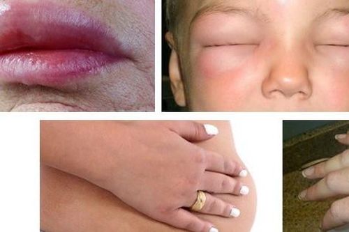 Nâng cao chất lượng chẩn đoán và điều trị cho bệnh nhân phù mạch di truyền