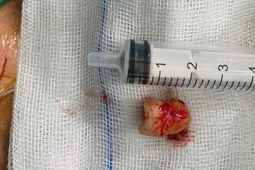 U nang thân răng trong xoang hàm - Một trường hợp hiếm gặp