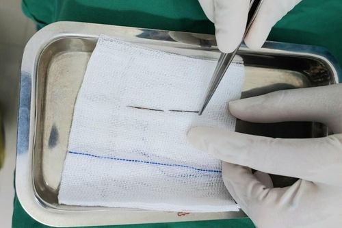 Bé trai 4 tuổi được tìm thấy chiếc kim khâu trong phổi