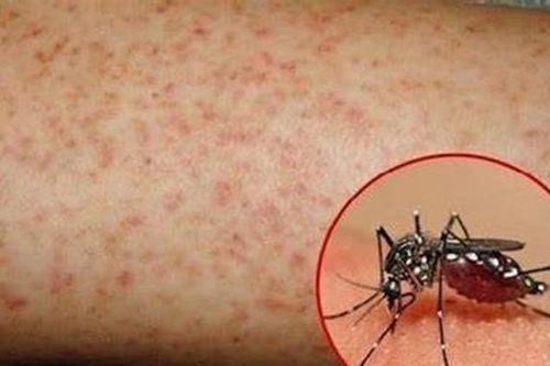 75% trường hợp tử vong do sốt xuất huyết là người lớn