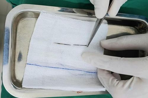 Vào viện khám gãy tay, bé trai phát hiện có kim khâu trong phổi