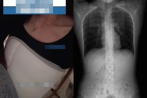 Cô gái gãy 4 xương sườn sau bữa ăn cay