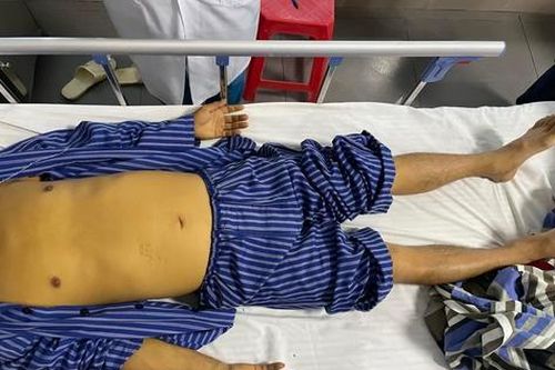 Cứu sống bệnh nhân nhiễm xoắn khuẩn vàng da