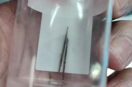 Phát hiện kim may rỉ sét dài 4-5cm trong phổi bé 4 tuổi