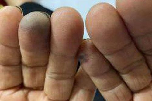 Khi lạnh cảnh giác với hội chứng Raynaud khiến ngón tay, chân xanh tím và đau buốt