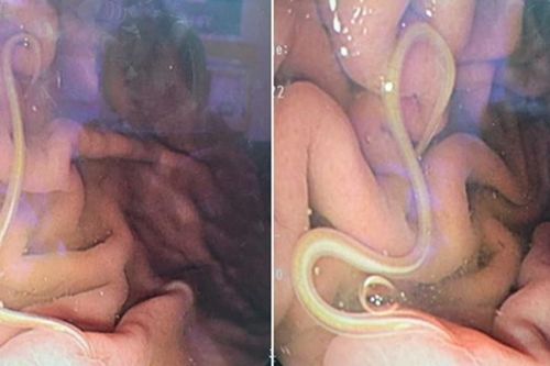 Cứ ăn món này là tiêu chảy, thanh niên trả giá vì sở thích