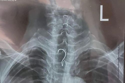 Gắp lưỡi câu dài 4cm trong thực quản cụ ông 83 tuổi