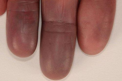 Hội chứng Raynaud khiến tay bị tím tái, đau buốt vào mùa đông