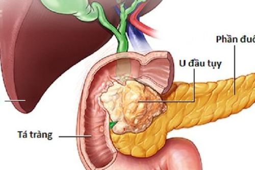 Hy vọng mới cho người mắc ung thư tụy