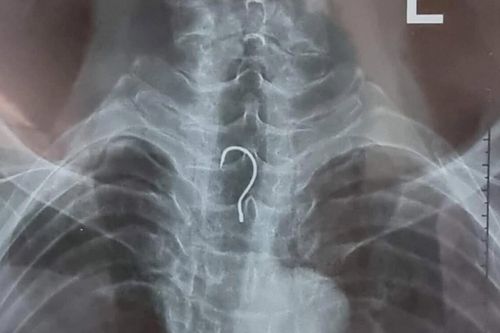 Hy hữu, nam bệnh nhân bị mắc lưỡi câu trong thực quản nhập viện khẩn