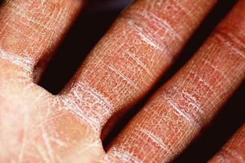 Liệu pháp mới điều trị bệnh viêm da dị ứng