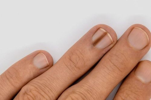 Phát hiện ung thư da qua vệt đen dài trên móng tay