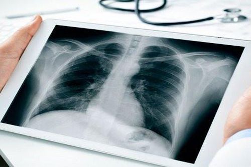 Khiến gần 24.000 người Việt tử vong mỗi năm, ung thư phổi có di truyền không?