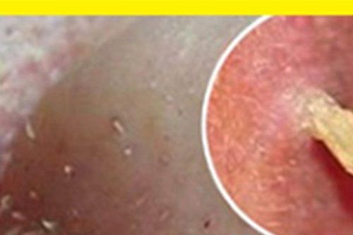 Mụn ẩn, mụn viêm, mụn đầu đen, đầu trắng: Đồng loạt trồi nhân lặn sạch nhờ mẹo nhỏ khó tin!