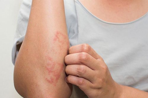 6 sai lầm khiến da nứt nẻ, gây ngứa vào ngày lạnh