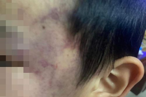 Bé trai 4 tuổi bị con cô giáo đánh tại trường