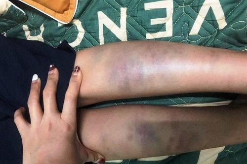 Vụ việc học sinh lớp 1 bị đánh tại trường tiểu học Nguyễn Phan Vinh không cấu thành tội phạm