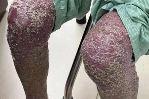 Hơn 50 năm đau đớn vì chứng bệnh 'da rắn'