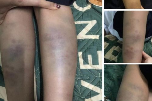 Vụ học sinh lớp 1 bị đánh bầm tím chân tay ở trường: Không khởi tố vụ án hình sự