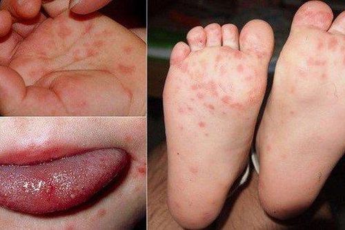 Trẻ bị chân tay miệng nên tắm lá gì?