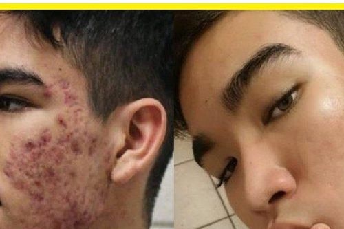 Con trai bị mụn viêm: Chấm dung dịch này mỗi tối sẽ hết mụn, không cần bôi kem với đi Spa như con gái!