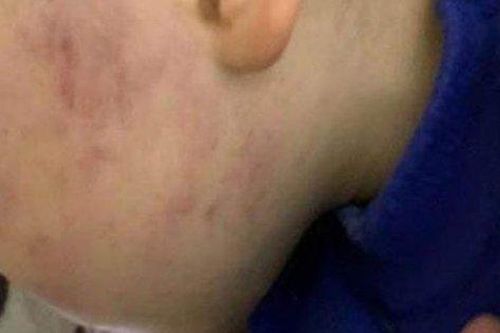 Bé 2 tuổi bị cô giáo tát bầm tím một bên má