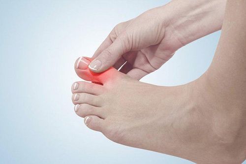 Các phương pháp tự nhiên giúp giảm nồng độ axit uric trong cơ thể