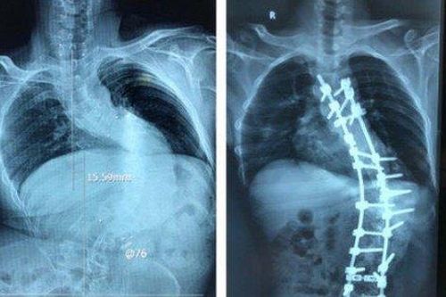 Tìm lại vóc dáng cho bệnh nhân bị biến dạng cột sống kèm gù hơn 100 độ
