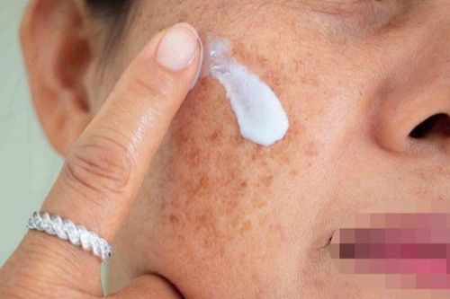 Cảnh báo mẫu kem chuyên nám có hàm lượng thủy ngân vượt mức