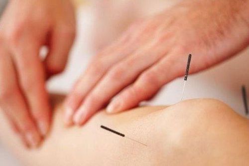 Lưu ý khi châm cứu điều trị viêm khớp dạng thấp