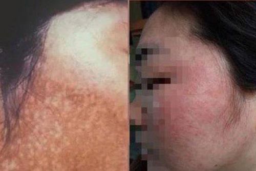 Cục quản lý Dược cảnh báo mẫu kem chuyên nám có hàm lượng thủy ngân vượt mức