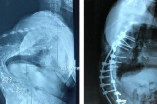 Cắt xương sườn lấy lại vóc dáng cho người 10 năm bị vẹo cột sống