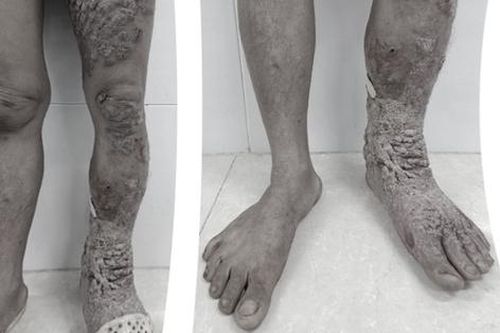 Thường xuyên tiếp xúc với đất, nước bẩn, chân người phụ nữ bị sần sùi, to như chân voi