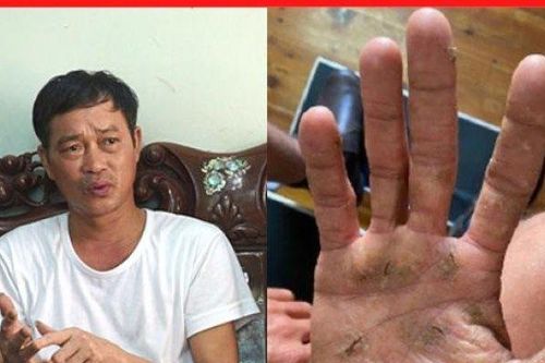 Tuyệt vọng vì viêm da ngứa gãi 'xoành xoạch', xem ngay mẹo này kẻo tiếc!