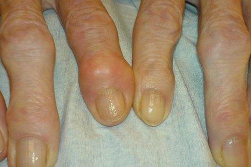 Một loại thuốc trị mụn có thể giúp chữa viêm xương khớp