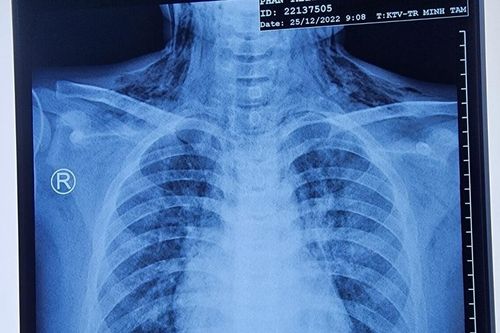 Cậu bé 11 tuổi vẫn bị hóc sặc dị vật, bác sĩ đưa ra khuyến cáo