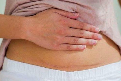 Hy hữu, một phụ nữ tắc ruột do bị dính buồng trứng và vòi trứng, bác sĩ khuyến cáo sau khi sinh mổ tuyệt đối không làm điều này