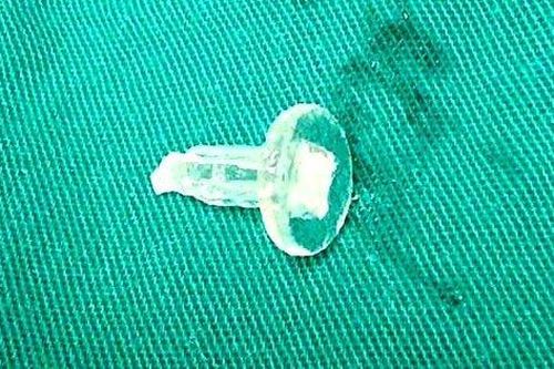 Bé trai 11 tuổi suýt chết vì thói quen ngậm bút bi