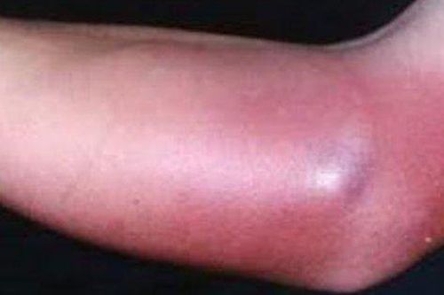 Sưng, nóng đỏ vùng da, thận trọng với viêm mô tế bào