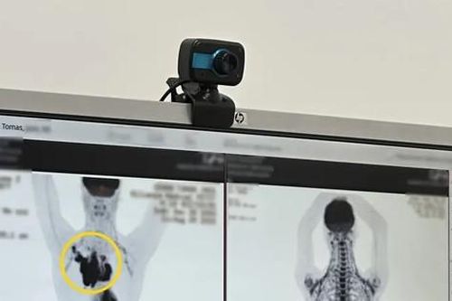 Chuyên gia tập gym cứ tưởng đau do tập luyện, hóa ra là khối ung thư