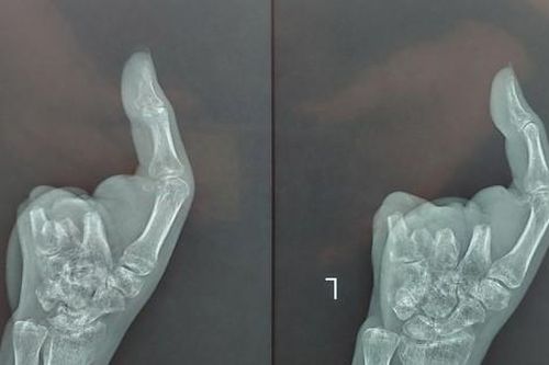 'Trồng' 2 ngón chân vào bàn tay bị máy xay thịt nghiền nát
