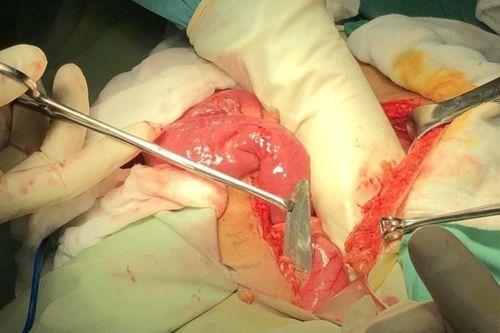 Cứu sống thanh niên nuốt lưỡi dao vào bụng