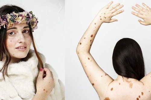 Mắc bệnh hiếm, cô gái có 1.200 nốt ruồi khắp cơ thể