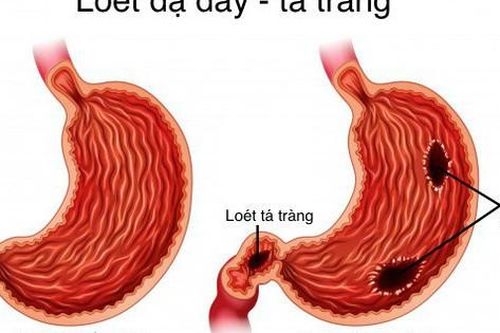 Các thuốc điều trị loét dạ dày tá tràng, dùng thế nào cho đúng?