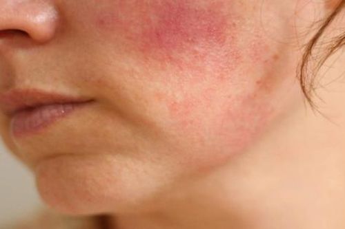 Bị viêm da cơ địa nên tránh những thực phẩm này để bệnh không 'vượng lên' khi thời tiết lạnh khô