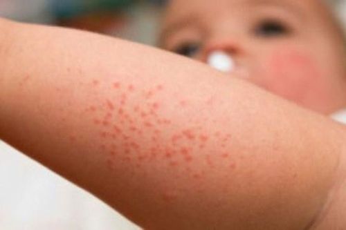 Không coi thường viêm da cơ địa ở trẻ nhỏ