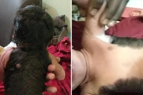 Kỳ lạ cậu bé sinh ra đã có lông, tóc khắp nửa người