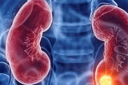 Ung thư thận có liên quan với bệnh suy thận mạn không?