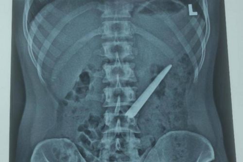 Thanh niên bất ngờ nhập viện với lưỡi dao nhọn dài khoảng 10cm trong bụng
