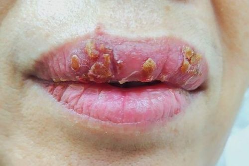 Nhiễm trùng môi vì làm đẹp cấp tốc
